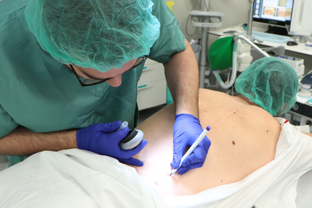 La teledermatologia permet quadruplicar els diagnòstics de càncer de pell gràcies a la coordinació entre l’Atenció Primària i l’Hospital de Viladecans